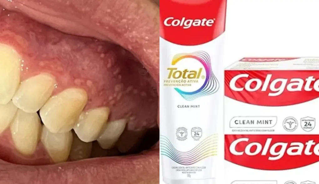 Anvisa Interdita Pasta de Dentes Colgate Clean Mint: Entenda os Riscos, Causas e Consequências